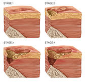 Illustration Showing The 4 Stages Of A Bedsore Or Pressure Sore Stock ...